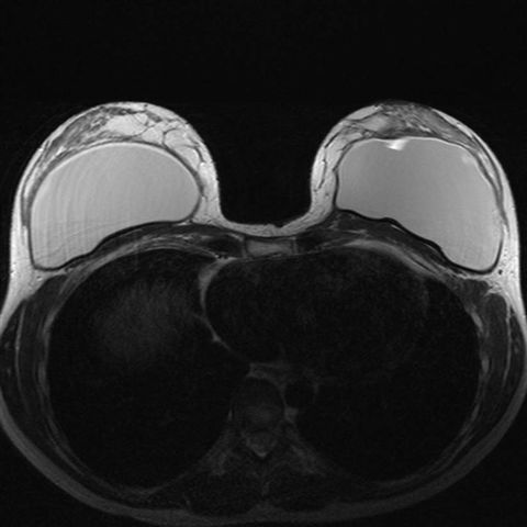 Read more about the article Breast MRI