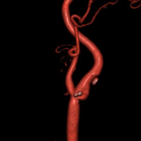Read more about the article Leg Arteries